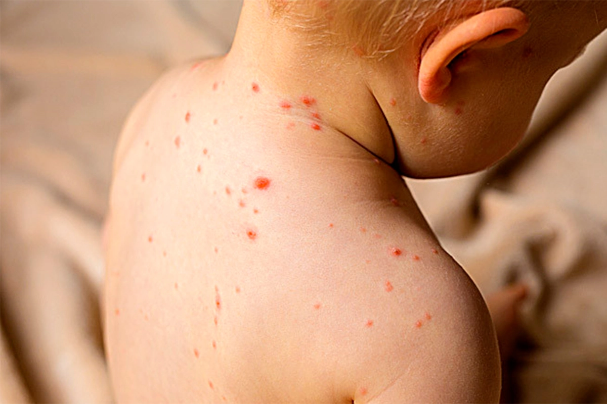 ALERTAN QUE EL SARAMPIÓN PUEDE PROVOCAR DISCAPACIDAD Y HASTA LA MUERTE DE NIÑOS: INSTAN A COMPLETAR LA VACUNACIÓN