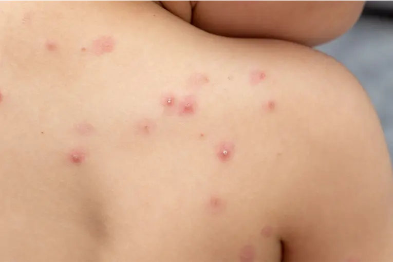 Viruela del mono en Argentina: riesgos y claves de la variante 1B