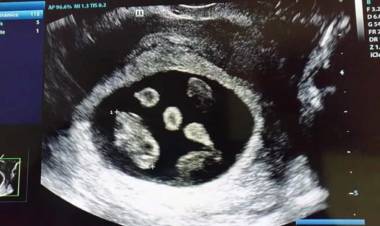 DOLOR Y LUCHA: MURIÓ UNA DE LAS TRIGEMELAS QUE NACIERON LA SEMANA PASADA EN CHUBUT