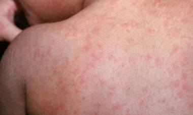 EN CASO DE QUE EL BROTE CONTINÚE, ADVIERTEN QUE EL PAÍS PODRÍA PERDER EL STATUS DE "PAÍS LIBRE DE SARAMPIÓN"