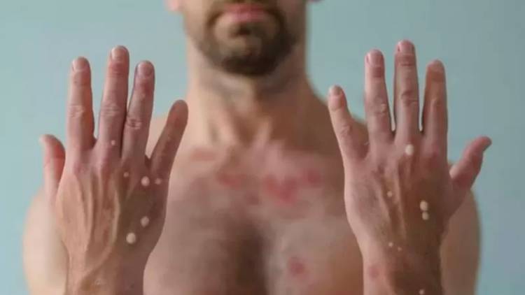 PREOCUPACIÓN POR LA VIRUELA DEL MONO: LA OMS DECLARA LA ALERTA MÁXIMA POR SUBA DE CASOS EN EL MUNDO